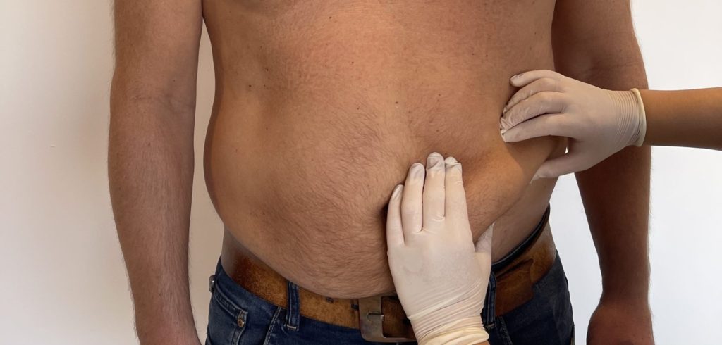 Fat Freezing Brabant - Veilig vet bevriezen met Cryolipolyse